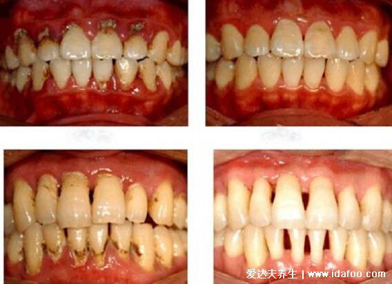 早期牙周炎圖片的癥狀表現(xiàn)，5大早期癥狀牙齦出血/口臭需警惕