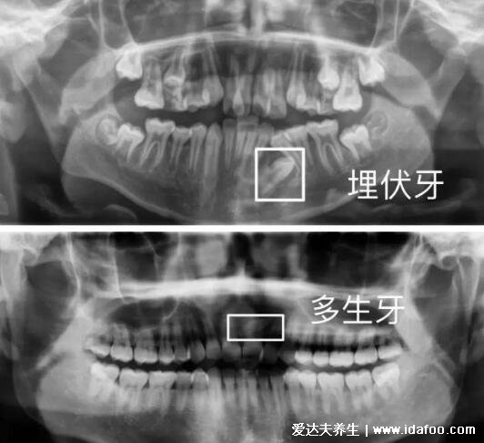 埋伏牙一定要拔嗎有什么危害，建議拔除有三大危害(附不需要拔的智齒圖片)