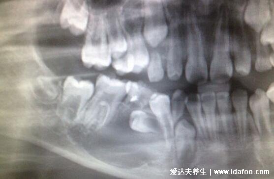 埋伏牙一定要拔嗎有什么危害，建議拔除有三大危害(附不需要拔的智齒圖片)
