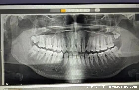 拔智齒后遺癥太多了，4個危害讓你拔了智齒后悔終身