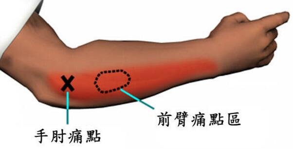 網(wǎng)球肘在哪個(gè)位置圖片，網(wǎng)球肘的按摩手法自我治療視頻圖解