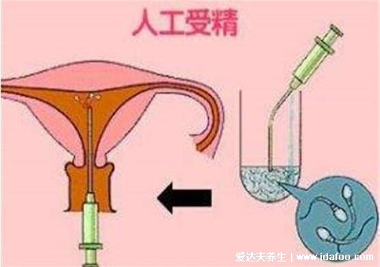 人工授精的過(guò)程與費(fèi)用，3-8千元一個(gè)周期成功率50%左右