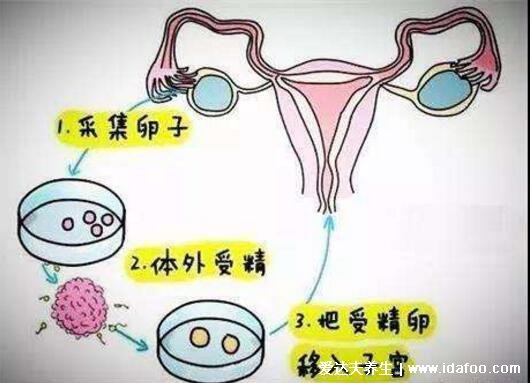 人工授精的過(guò)程與費(fèi)用，3-8千元一個(gè)周期成功率50%左右