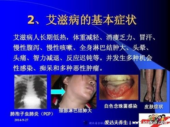 女人艾滋病的三大癥狀圖片，注意私處感染有分泌物/皰疹易糜爛