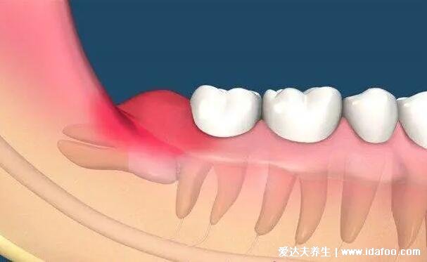 拔智齒后那個(gè)洞臭到惡心，拔牙后3-5天痛不欲生警惕干槽癥