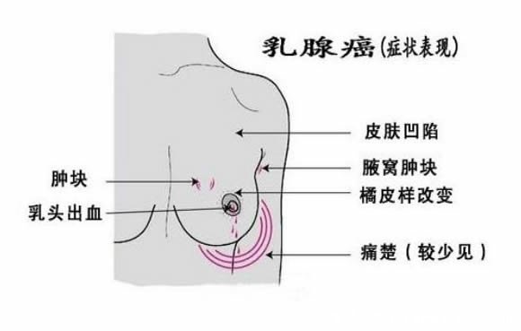 乳腺癌早期癥狀圖片，乳房出現(xiàn)凹陷/乳頭溢液等癥狀需盡快治療