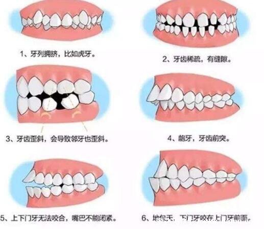 牙齒矯正最佳年齡段，12-18歲最佳可分為三個(gè)階段(無年齡限制)