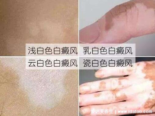 如何判斷白斑是不是白風(fēng)圖片，無皮屑顏色乳白日曬后灼痛