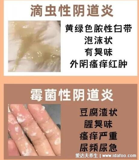 怎么判斷霉菌還是滴蟲圖片，霉菌豆腐渣樣白帶很瘙癢