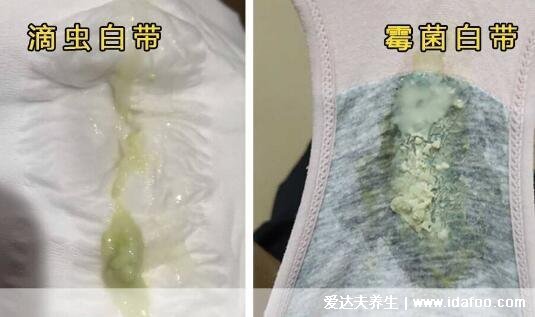 怎么判斷霉菌還是滴蟲圖片，霉菌豆腐渣樣白帶很瘙癢