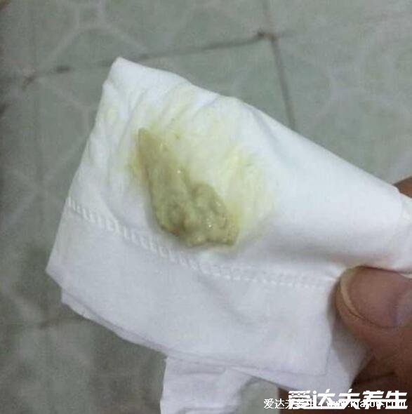 怎么判斷霉菌還是滴蟲圖片，霉菌豆腐渣樣白帶很瘙癢