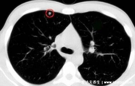 肺上結(jié)節(jié)80%是肺癌圖片，警惕生長速度很快的結(jié)節(jié)(95%是良性)