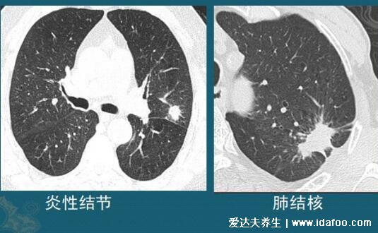 肺上結(jié)節(jié)80%是肺癌圖片，警惕生長速度很快的結(jié)節(jié)(95%是良性)