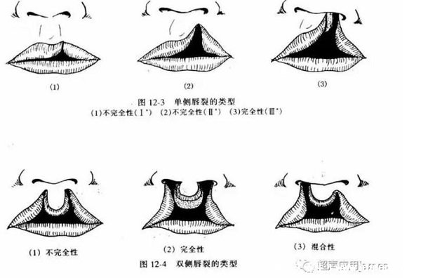 唇腭裂圖片是什么樣子圖片，1側(cè)或2邊嘴巴開(kāi)裂(孕早期要預(yù)防)