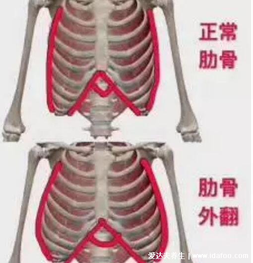 肋骨外翻圖片對比，可影響外觀出現(xiàn)雞胸及器官的受損