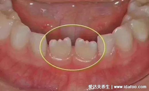 兒童換牙順序圖20顆，八歲兒童有幾顆牙(6歲開始恒牙替換乳牙)