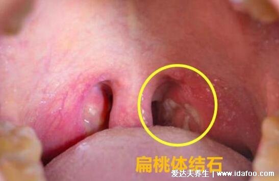 扁桃體結(jié)石脫落小妙招圖片，口腔里吐出了個小黃粒巨臭