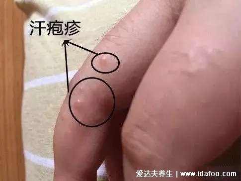 手上老是長“小水泡”，這是怎么回事？