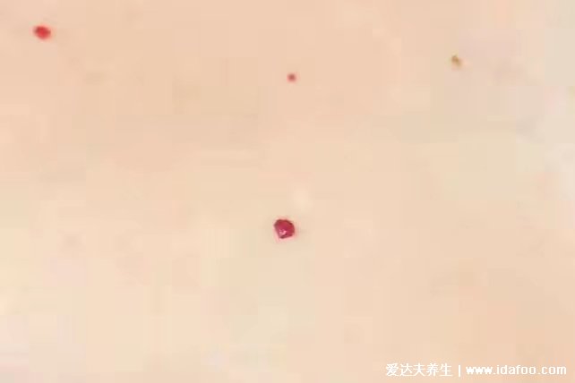 皮膚出現(xiàn)這些小紅點時刻反映身體變化