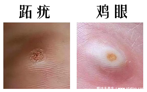 眼瞼脖子和腋下長的小肉粒是什么，到底是不是感染HPV病毒