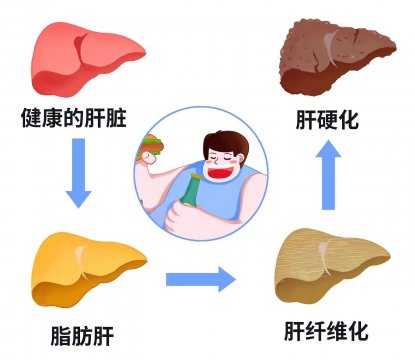 堅(jiān)持三個(gè)護(hù)肝秘訣，有效改善肥胖性脂肪肝對(duì)身體的危害