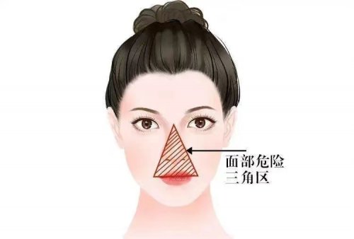 危險(xiǎn)三角區(qū)的痘痘不能擠