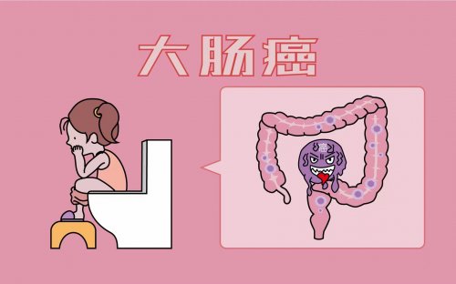 95%的大腸癌竟由腸息肉轉(zhuǎn)變而來上廁所有這3個提示要警惕