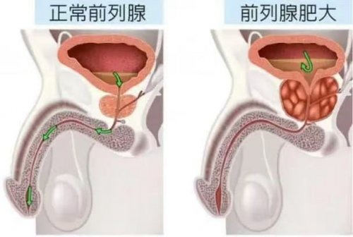 男人逃不掉的麻煩前列腺變大這5個習(xí)慣要當心